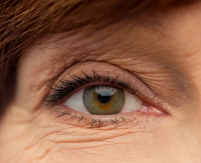 Blefaroplastia Sem Corte