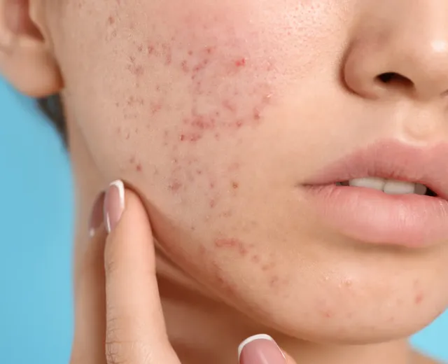 Cicatrizes de Acne