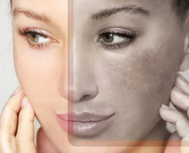 Melasma e Manchas