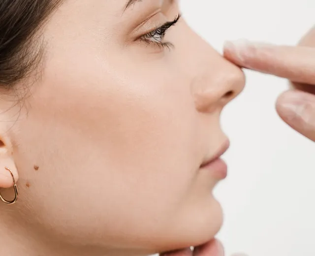 Perfiloplastia